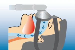 С помощью вентиляции лёгких под давлением при наличии синдрома сонного апноэ обеспечивается равномерное насыщение крови кислородом. Выпускается большое количество самых разных моделей масок для СиПАП – терапии.